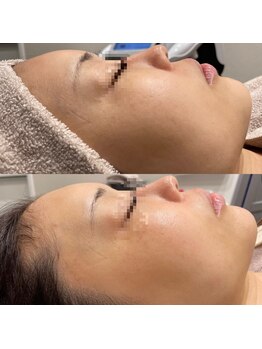 ビュウナ 銀座(BEAUNA)/シルクブライト