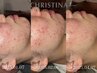 【話題の】ハーブピーリング♪毛穴の引き締め、ニキビにも効果的! ¥14,850