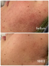 エリーズ(Elise)/肌質改善（ハーブピーリング）