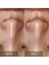 アロハーブ/ララピール