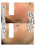 【モニター様価格!!】BBL光フェイシャル¥13,200→￥3,300