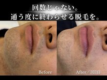 ダイヤ 名古屋中川区店(Daiya)/メンズ脱毛/3回で変わったヒゲ