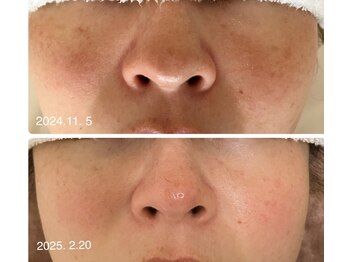 ムク(MUKU 無垢)/シミケア