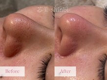 芯美 恵比寿店(shinbi)/毛穴洗浄オプション/小鼻/毛穴