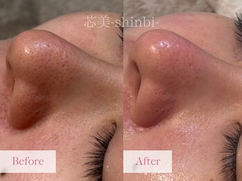 芯美 恵比寿店(shinbi)/毛穴洗浄オプション/小鼻/毛穴