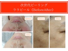 Cスキンケアクリニック 麻布店/ララピールBeforeAfter#麻布十番