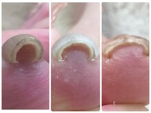 巻き爪、剥離、爪のお悩みはさまざま。カウンセリングで確認！