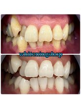 ホワイトニングショップ 吉祥寺2号店/コンプレックスも