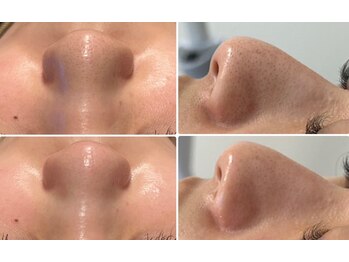 八女整体院/~ハイドラ毛穴洗浄~