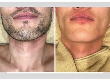 ルシェリ(Lecheri)/ひげWax＋光　ダブル脱毛♪