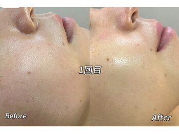 メイ 葛西(Mei)/毛穴レス肌へ導く施術