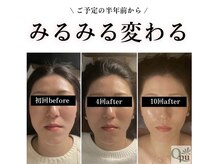 キュープ 高崎店(Qpu)/小顔頭蓋骨矯正＋オイルケア