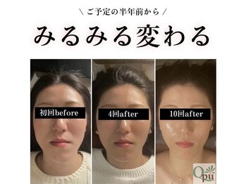 キュープ 高崎店(Qpu)/小顔頭蓋骨矯正＋オイルケア