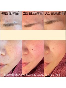 ソレヴィア(SOLEVIA)/【シミケア】施術の経過