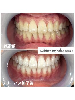 ホワイトニングサロン 京都烏丸店/ホワイトニング施術例