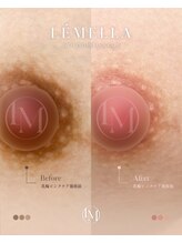 エルビービュティーサロン(LB BEAUTY SALON)/【ルメラ乳輪】実績数関西1★