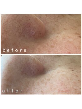 メナードフェイシャルサロン 岐阜茜部/紫外線ダメージケア