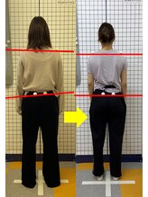 ひよこ整骨院/骨盤矯正Before→Ａfter