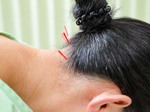 キュアハンズ 大森/首・肩のコリに鍼を　