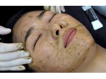 モモン シャルールの雰囲気(ハーブの微細針が浸透し肌を覚醒!生まれ変わるような美しさへ。)