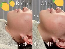 ルル(Lulu)の雰囲気（韓国美容☆小顔レモンボトルで驚きのBefore/after/短期で小顔に!）