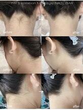 エムズスタイル ネイルバー(M's Style NAIL BAR)/うなじ脱毛