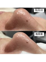 メンズー(MENZOO)/毛穴クリーンケア