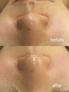 サロンモリ(Mori)/毛穴洗浄×ハーブピーリング