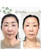 木の葉/40代/むくみ,輪郭,お顔を小さく