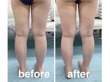 ハロ 南青山(HALO)/キャビテーション+ラジオ波