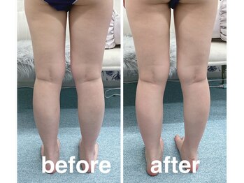 ハロ 南青山(HALO)/キャビテーション+ラジオ波