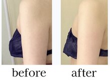 ヒトハナ(hitohana)/頑固な二の腕も一度でスッキリ◎