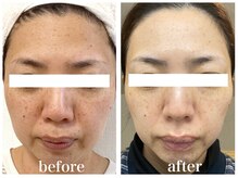 ルー ハナレ 神戸岡本 摂津本山店(Luu HANARE)/9ヶ月小顔シミ改善・たるみ改善