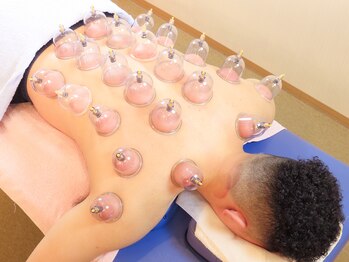 坂下通りべんてん鍼灸 整骨院/カッピングもあります!