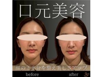 チョコバリ 郡山店(chocobari)/小顔×リフトアップ(美容鍼)20代