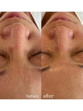 リーミー(Re:me)/★ざらつき/凸凹肌改善します★