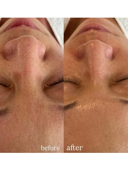 リーミー(Re:me)/★ざらつき/凸凹肌改善します★