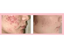 キッカ 梅田天六(Kikka)/繰り返す赤ニキビに！