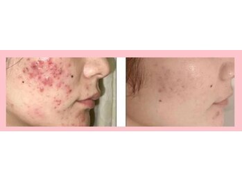 キッカ 梅田天六(Kikka)/繰り返す赤ニキビに!