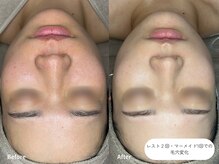 フォンビューティー(fon beauty)/ブライダル１ヶ月・3回