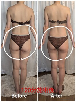 フィニシオン/たった1回の施術でこの変化！