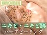 【本格ニキビケア◇DT約3～5日翌日からメイクOK】韓国発ハーブピーリング