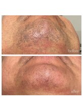 ハピネスビューティーサロン(happiness beauty salon)/脱毛/メンズ/レディース/お髭