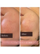 アンベリール(Embellir)/ハーブ＆毛穴ニキビケア鎮静