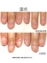 ブリエネイル/20代/深爪/3ヶ月後アフター