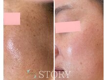 ストーリー(STORY)/ハーブピーリング専門店STORY