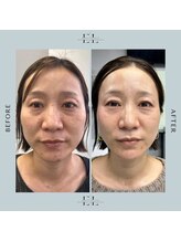 ホワイトラボ 姫路(White labo)/【施術例】エクソリフト/ExoLift