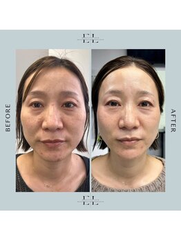 ホワイトラボ 姫路(White labo)/【施術例】エクソリフト/ExoLift