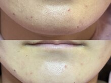 エミュ(emu)/顎のざらつきさようなら