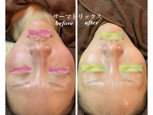 セラ(SERA)の雰囲気（【サーマトリックス】透明感・弾力UPで小顔・リフトUP♪）